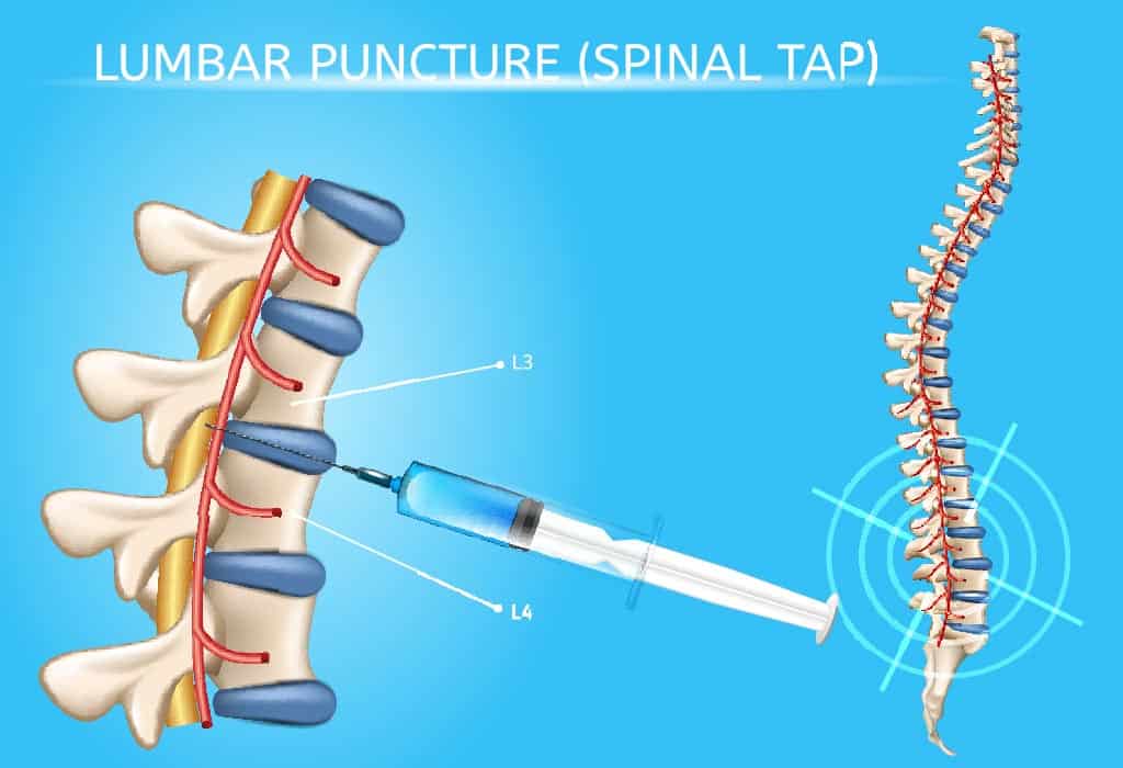  Xét nghiệm chọc dò tủy sống ở trẻ em: Hướng dẫn toàn diện cho cha mẹ