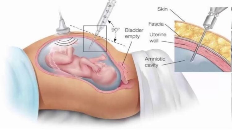  Chọc ối: Thủ thuật sàng lọc trước sinh để chẩn đoán dị tật bẩm sinh