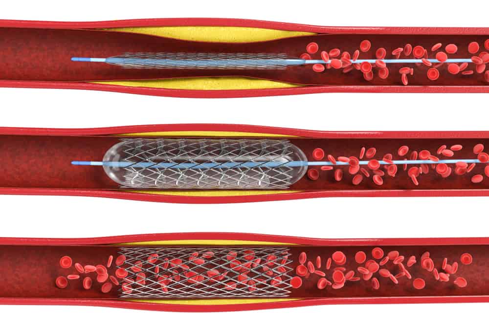  Quy trình Đặt Stent: Loại, Biến chứng và Hướng dẫn Sau thủ thuật