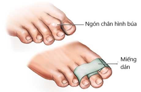  Ngón chân hình búa: Nguyên nhân, Triệu chứng và Biện pháp Điều trị