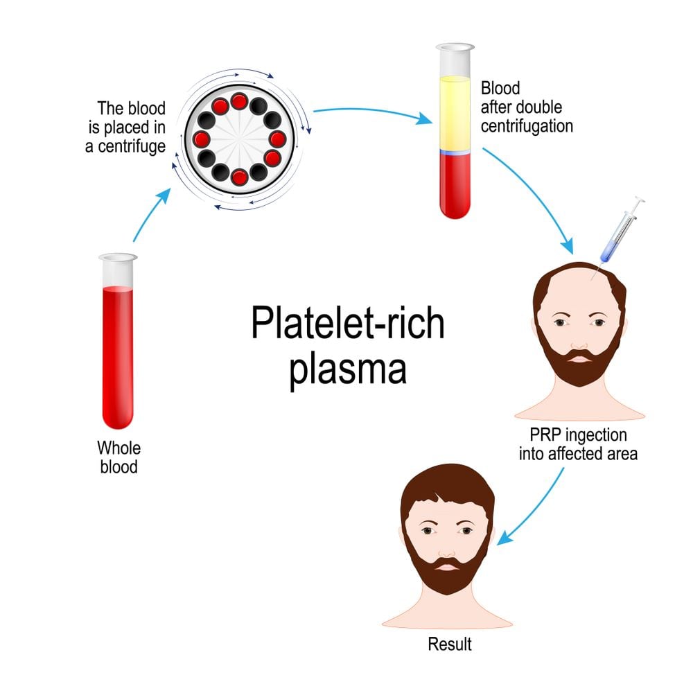  PRP Trị Rụng Tóc: Phương Pháp Tiên Tiến Kích Thích Tóc Mọc Lại