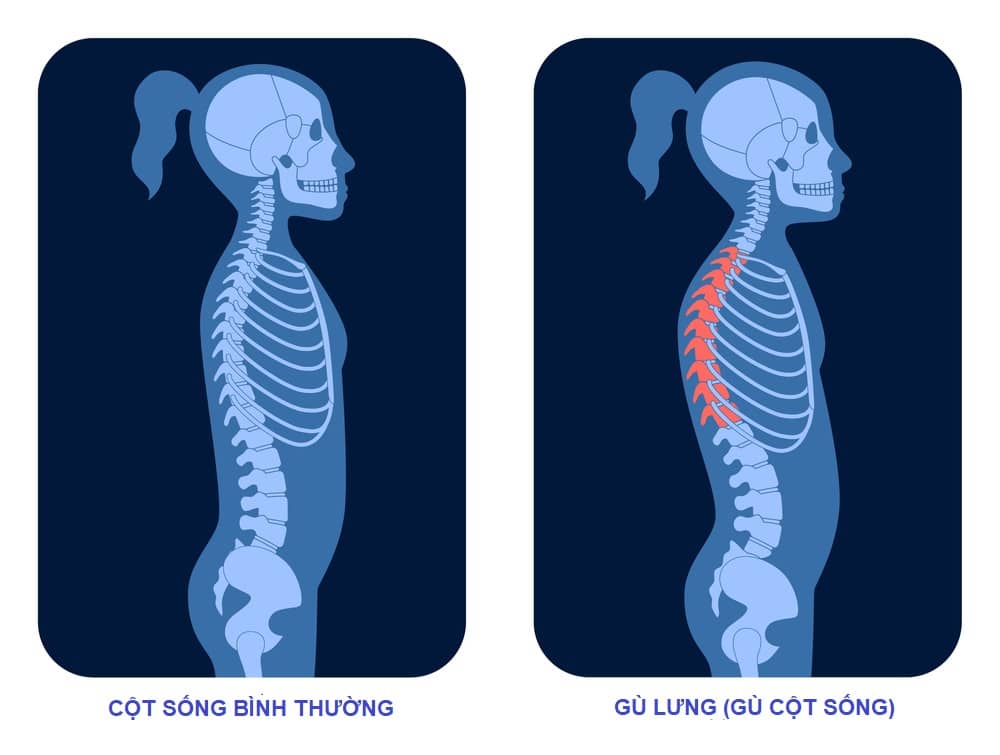  Gù lưng trẻ em: Nguyên nhân, triệu chứng và phương pháp điều trị