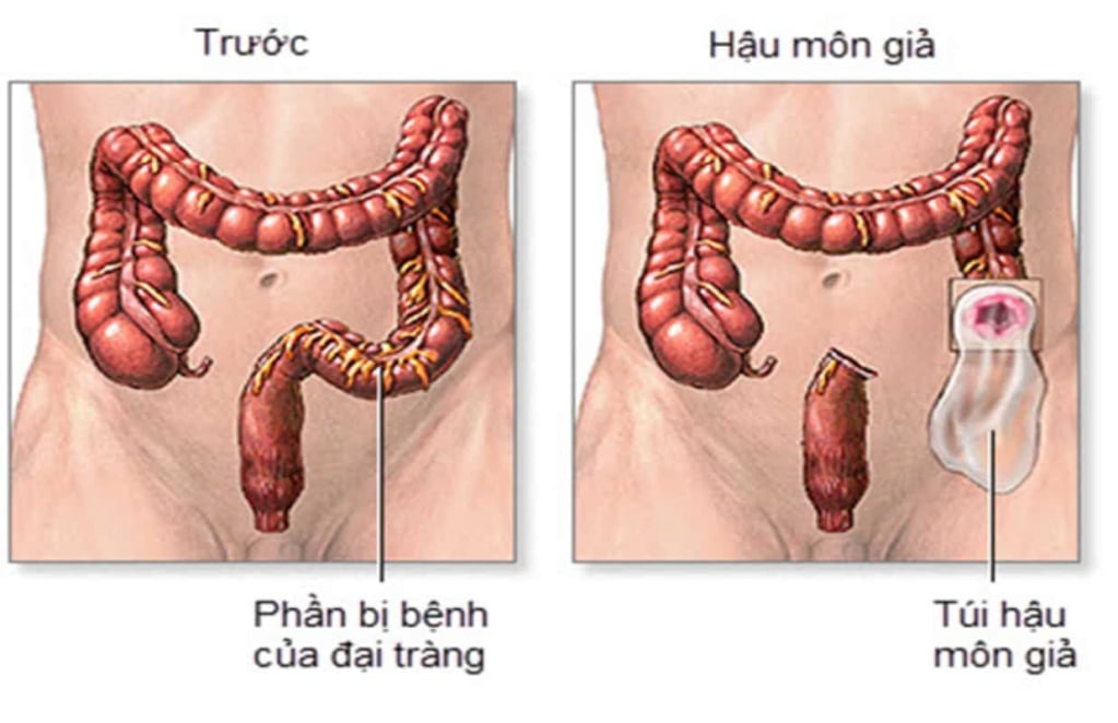  Phẫu Thuật Hậu Môn Nhân Tạo: Tất Cả Những Điều Bạn Cần Biết