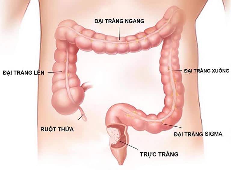  Phẫu Thuật Hậu Môn Nhân Tạo: Tất Cả Những Điều Bạn Cần Biết