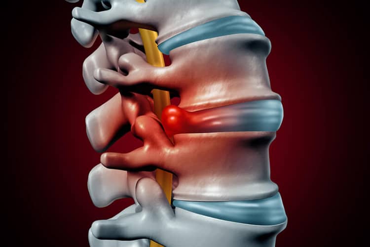  Lồi đĩa đệm: Triệu chứng, Nguyên nhân, Chẩn đoán và Điều trị