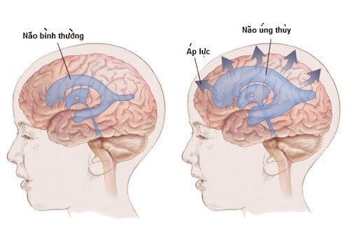  Bệnh não úng thủy ở trẻ sơ sinh: Nguyên nhân, triệu chứng, chẩn đoán và điều trị