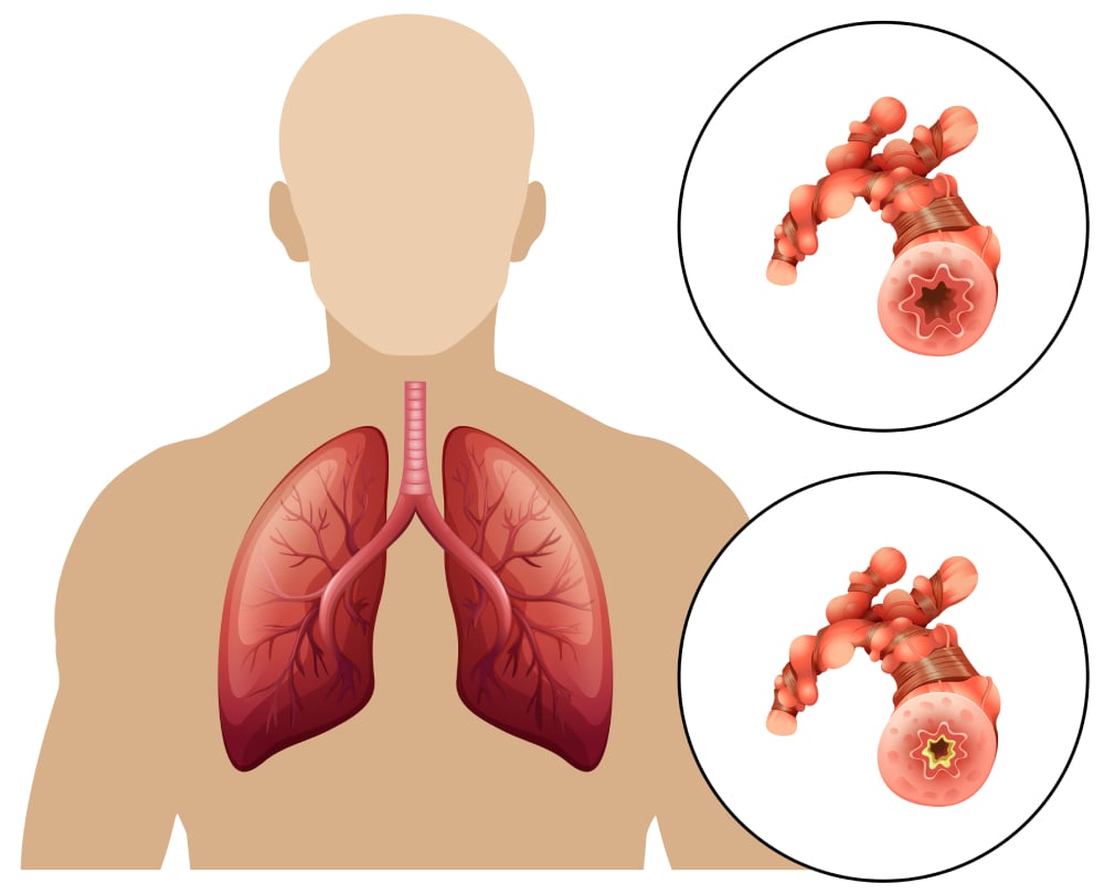  Tâm phế mạn: Một hướng dẫn toàn diện về nguyên nhân, triệu chứng và phương pháp điều trị