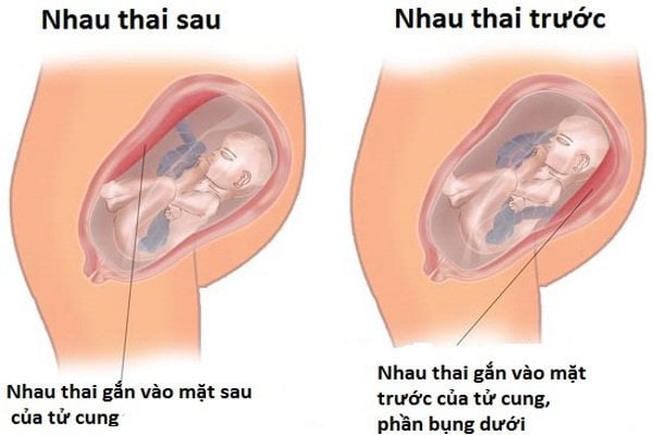  Nhau Thai Bám Mặt Trước: Vị Trí, Ảnh Hưởng và Chăm Sóc