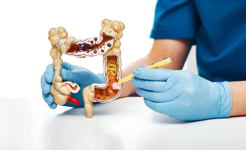  Polyp đại tràng: Tổng quan, nguyên nhân, triệu chứng, chẩn đoán và điều trị