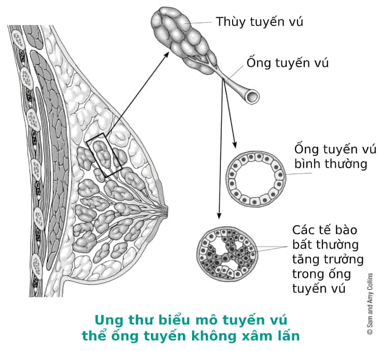  Ung thư biểu mô ống tuyến vú không xâm lấn: Hiểu biết sâu sắc về bản chất, chẩn đoán và điều trị