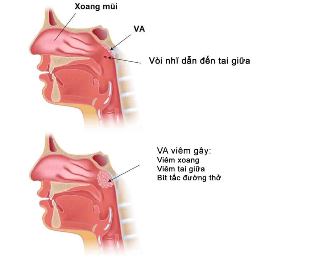  Viêm VA: Nguyên nhân, Triệu chứng, Chẩn đoán và Điều trị