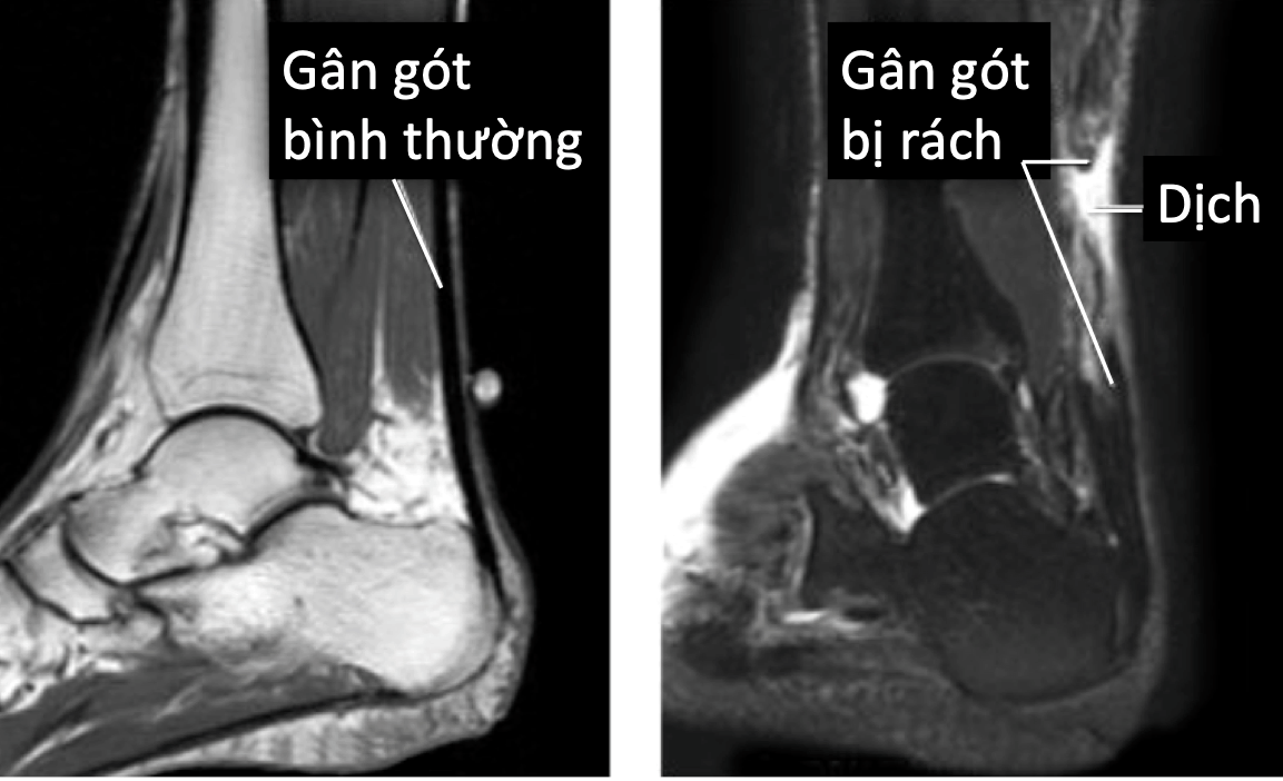  Đứt Gân Gót Chân: Tổng Quan, Nguyên Nhân, Triệu Chứng và Điều Trị