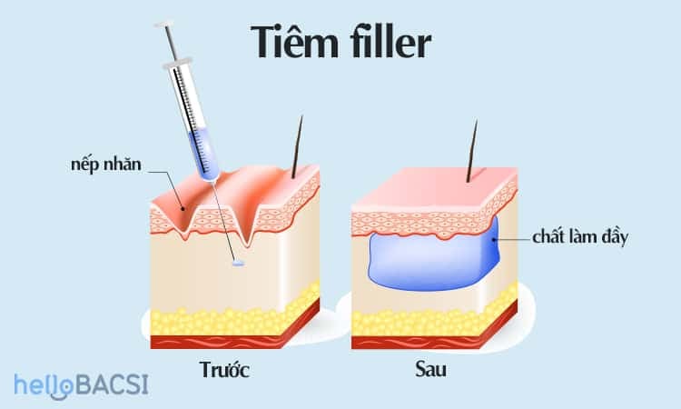  Botox và Filler: Hướng dẫn chi tiết về hai phương pháp làm đẹp phổ biến