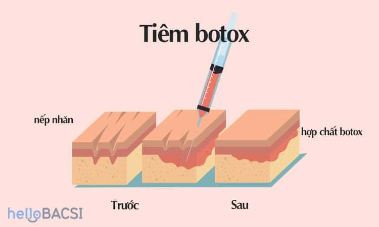  Botox và Filler: Hướng dẫn chi tiết về hai phương pháp làm đẹp phổ biến