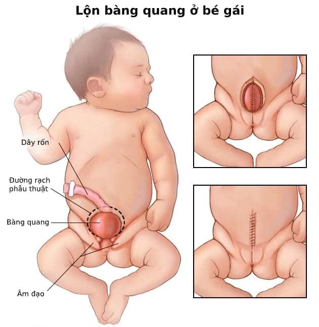  Lộn bàng quang: Nguyên nhân, Triệu chứng, Chẩn đoán và Điều trị