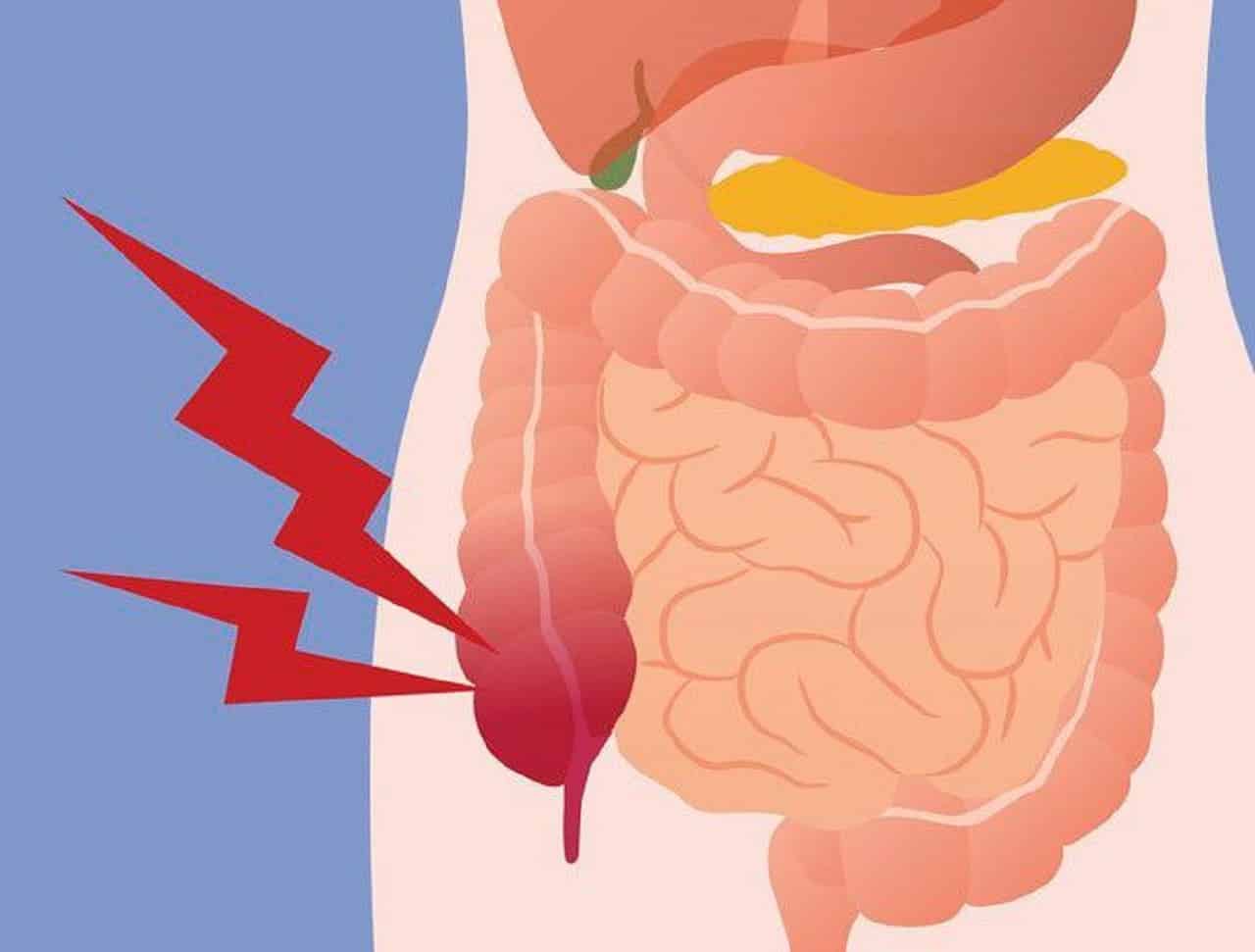  Viêm Ruột Thừa Mãn Tính: Hướng Dẫn Toàn Diện Về Nguyên Nhân, Triệu Chứng và Điều Trị