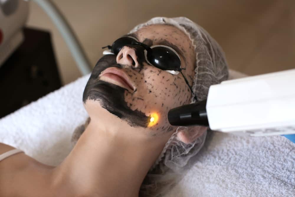  Laser Carbon Peel: Phương pháp trẻ hóa làn da không xâm lấn