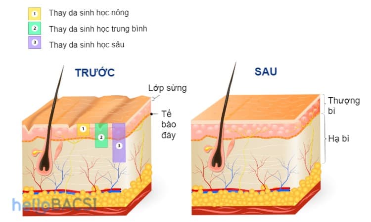  Thay Da Hóa Học Trị Sẹo Mụn: Hướng Dẫn Toàn Diện Từ A đến Z