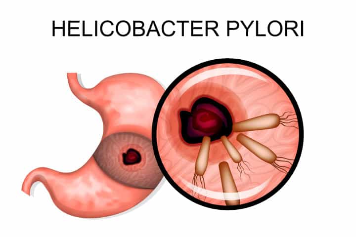  Nhiễm khuẩn H. pylori: Nguyên nhân, Biến chứng và Phương pháp chẩn đoán