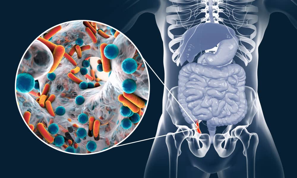  Viêm Ruột Thừa: Phẫu Thuật Có Cần Thiết Khi Ở Giai Đoạn Nhẹ?