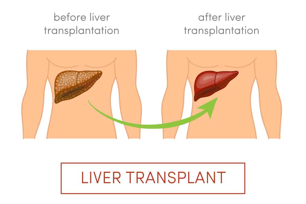  Suy gan cấp: Nguyên nhân, Biến chứng và Phương pháp điều trị