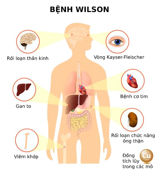  Bệnh Wilson: Một Rối Loạn Di Truyền Hiếm Gặp Ảnh Hưởng Đến Sự Tích Tụ Đồng