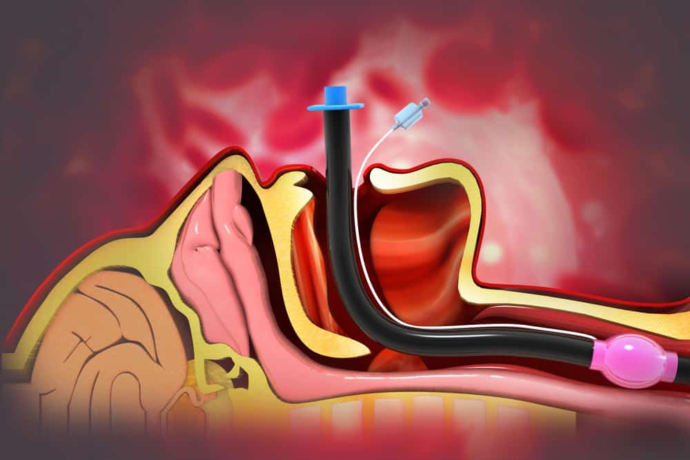  Đặt nội khí quản: Một phương pháp thiết yếu trong hồi sức, cấp cứu và gây mê