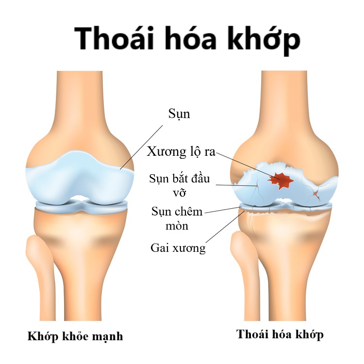  Thoái hóa khớp: Biến chứng, Nguyên nhân và Phương pháp điều trị