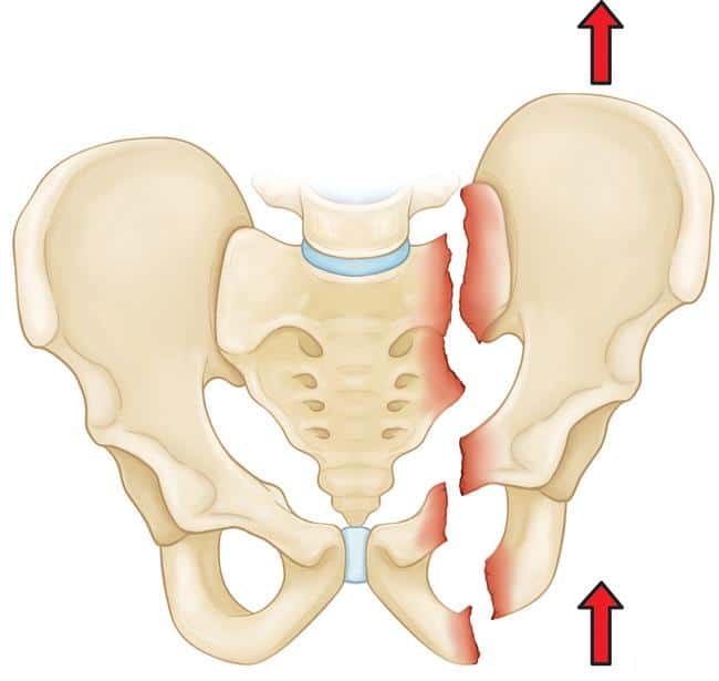  Gãy xương vùng chậu: Nguyên nhân, triệu chứng và phương pháp điều trị