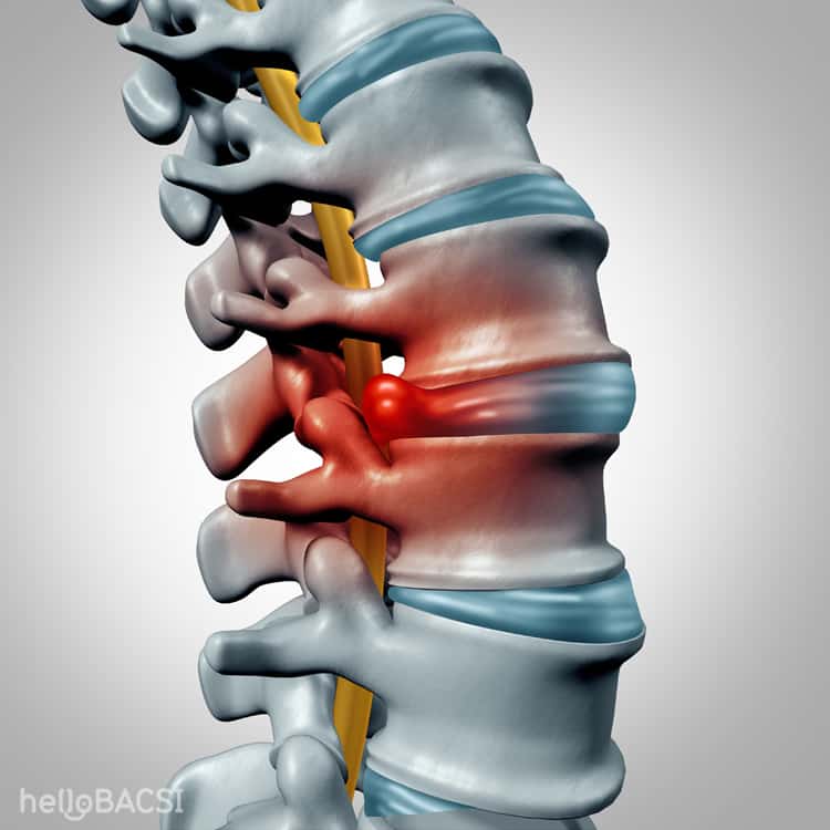  Phồng đĩa đệm: Nguyên nhân, triệu chứng và phương pháp điều trị