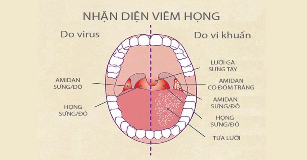  Viêm Họng: Nguyên Nhân, Triệu Chứng, Chẩn Đoán và Điều Trị